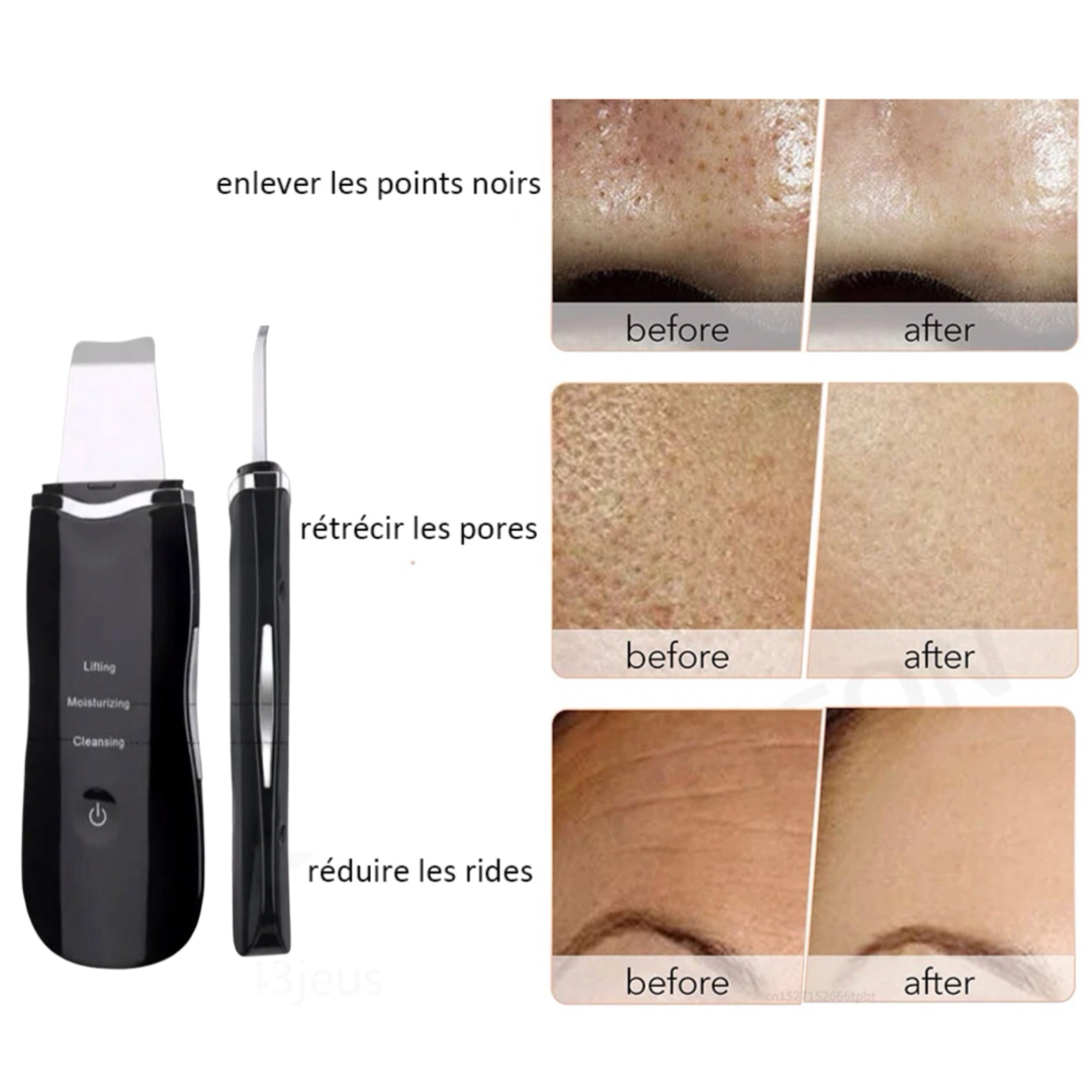 Épurateur de Peau à Ultrasons, Dissolvant de Points Noirs, Nettoyage en Profondeur du Visage